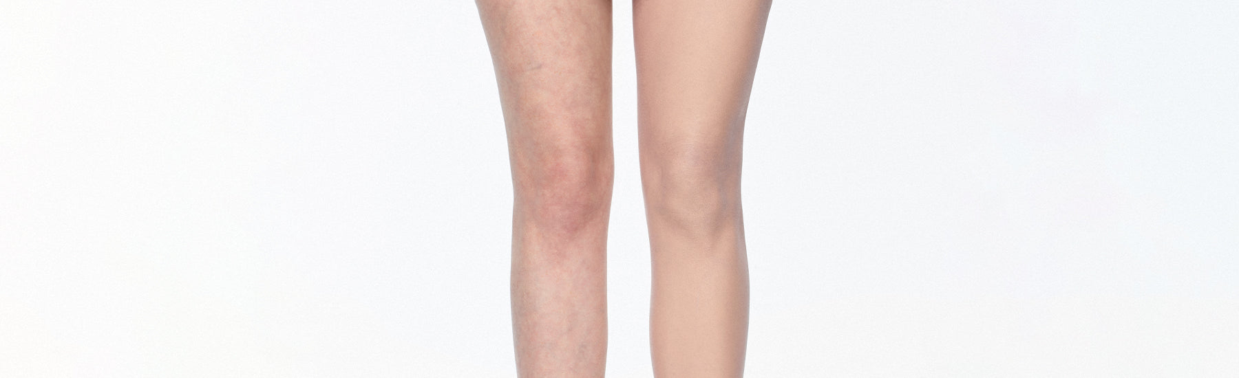 Makeup to Cover Varicose Veins