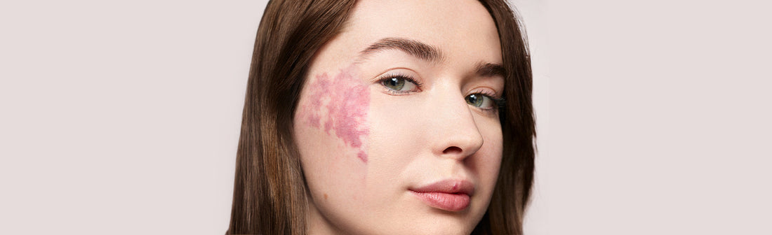 Bailey R Birthmark Face Birthmark Cover Up – Dermablend Professional