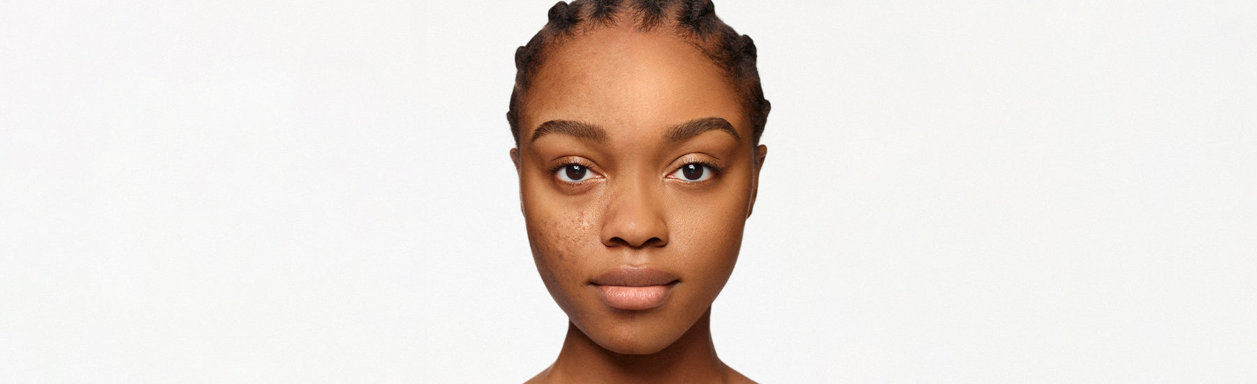 Best Makeup for Acne